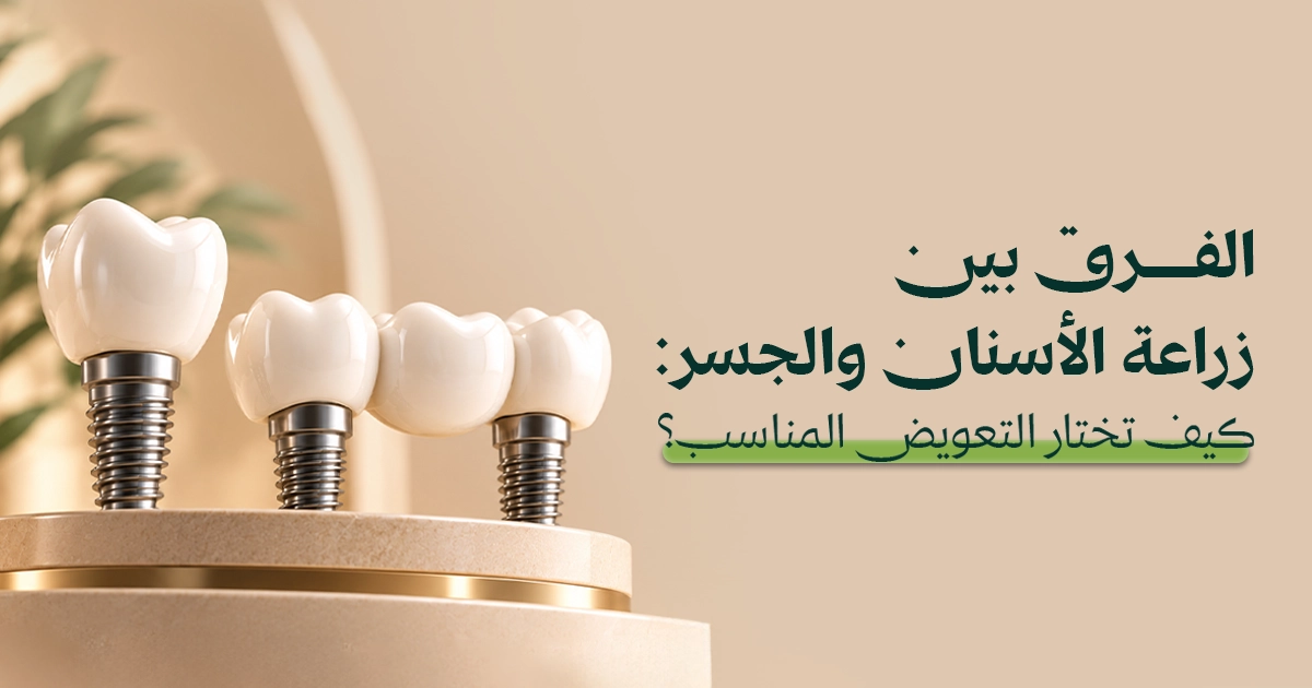 الفرق بين زراعة الأسنان والجسر