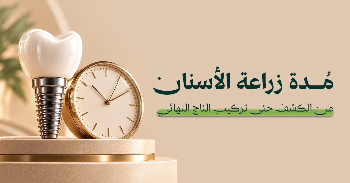 مدة زراعة الأسنان